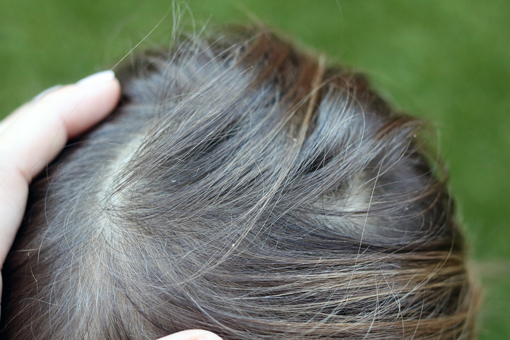 piojos pelo rizado